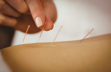 Acupuncture